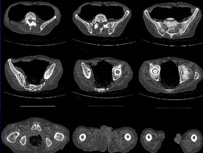 Mako RoboticArm Surgery Hip Replacement Surgery Orthopedic Surgeons