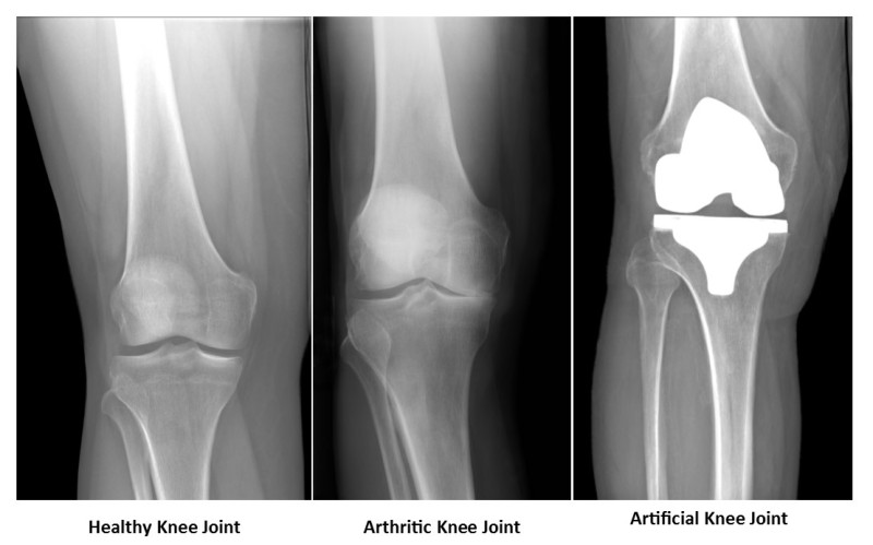 Knee Replacement Pictures 106