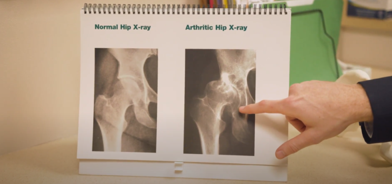 Anterior vs. Posterior Hip Replacements