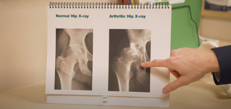 Hip Pain, Hip Injury, Hip Replacement Surgery