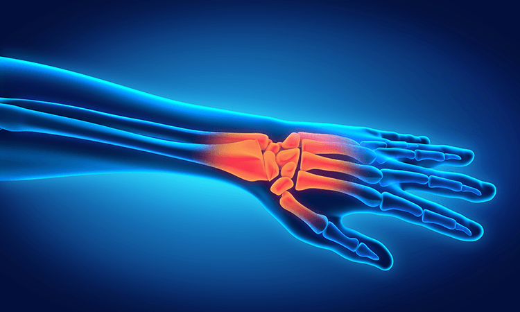 5 Common Symptoms of Carpal Tunnel Syndrome