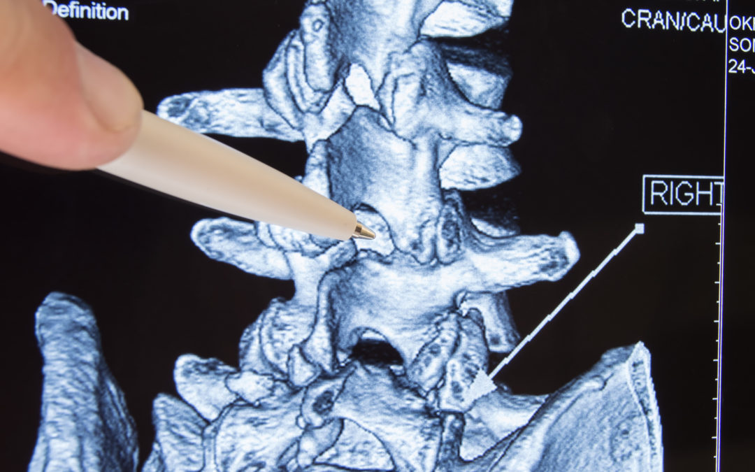 Nonsurgical Treatment for Back Pain