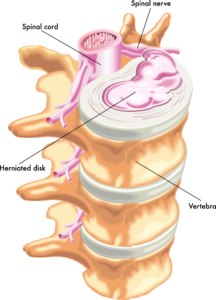 Is My Pain Caused By A Pinched Nerve Or A Herniated Disk?: Louisiana Pain  Specialists: Pain Management