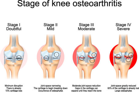 A Comprehensive Guide to Knee Arthritis | The Center Oregon
