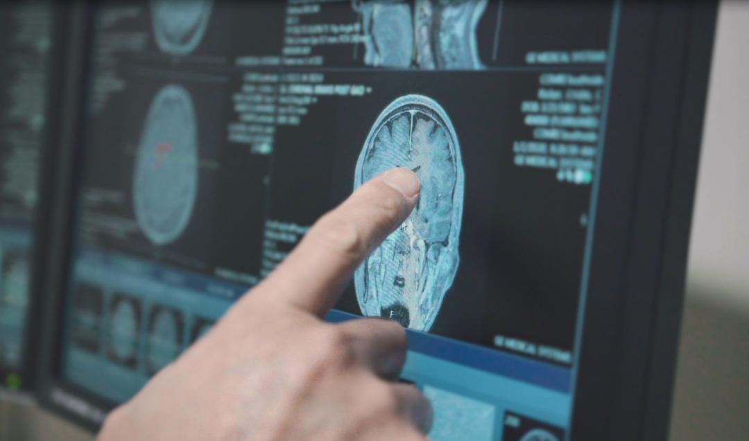 Stroke Awareness and Prevention