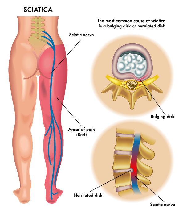 https://www.thecenteroregon.com/wp-content/uploads/2022/01/sciatica2.jpg