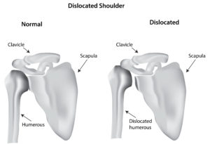 dislocated shoulder image