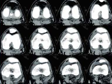 CT Scan of knee