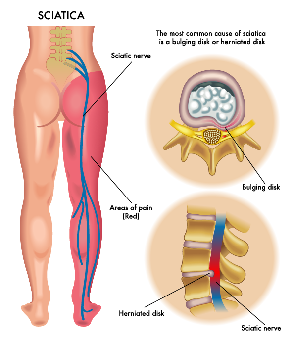 illustration of sciatica